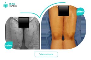 Thigh liposuction in iran before after photos