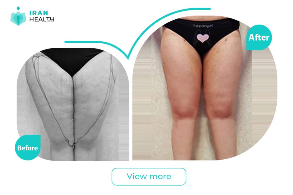 Thigh liposuction in iran before after photos