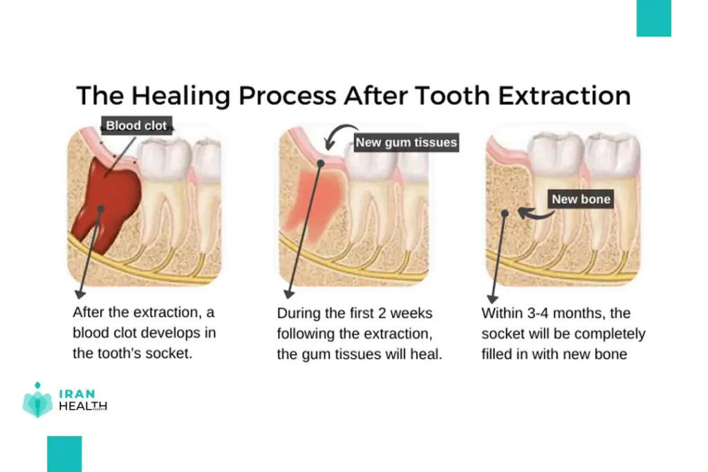 Types of extraction
