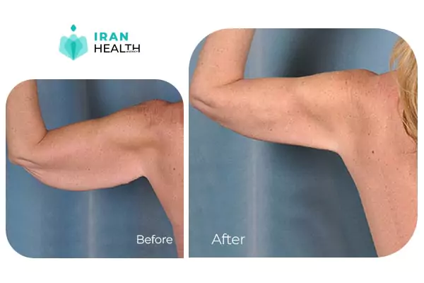 arm lift before after photos in iran