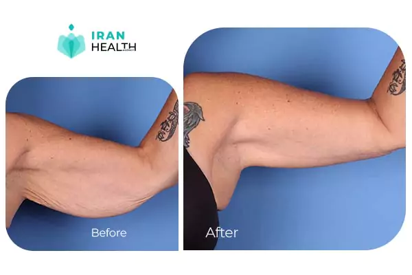 arm lift before after photos in iran