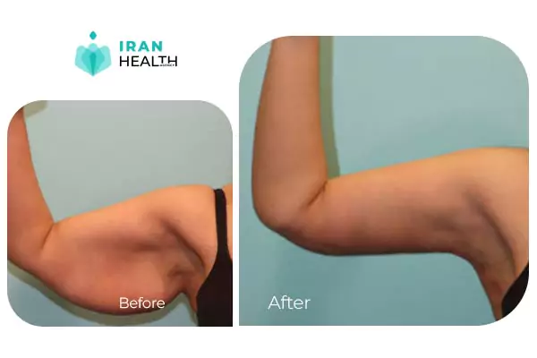 arm lift before after photos in iran (8)