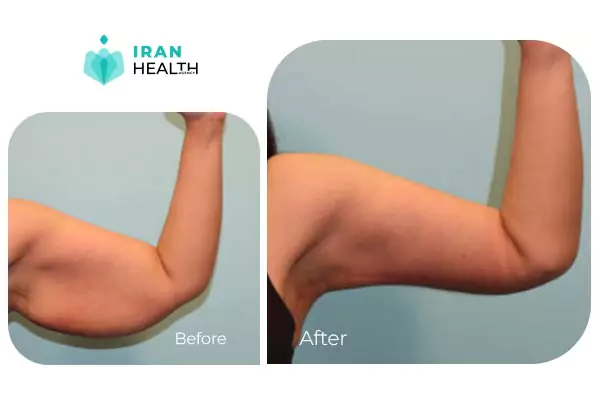 arm lift before after photos in iran (8)