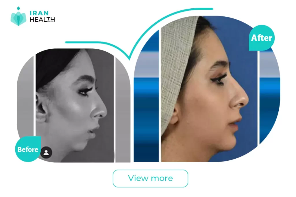 chin implant in iran before after