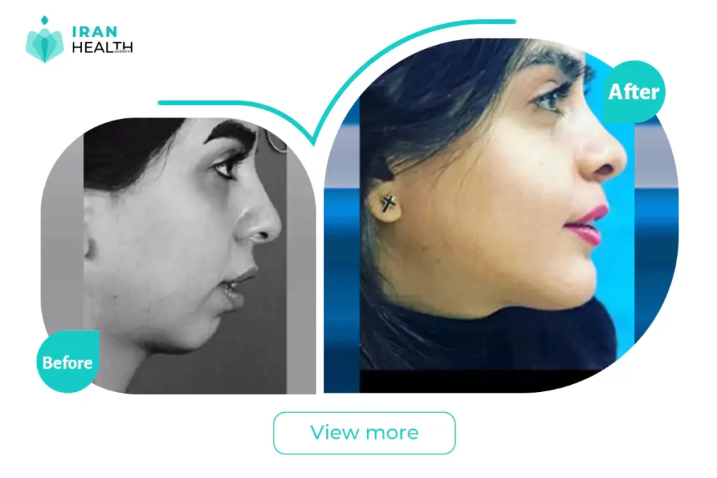 chin implant in iran before after