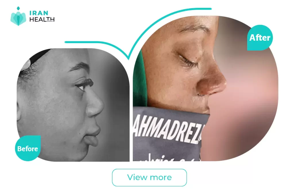 ethnic rhinoplasty in Iran before after photos