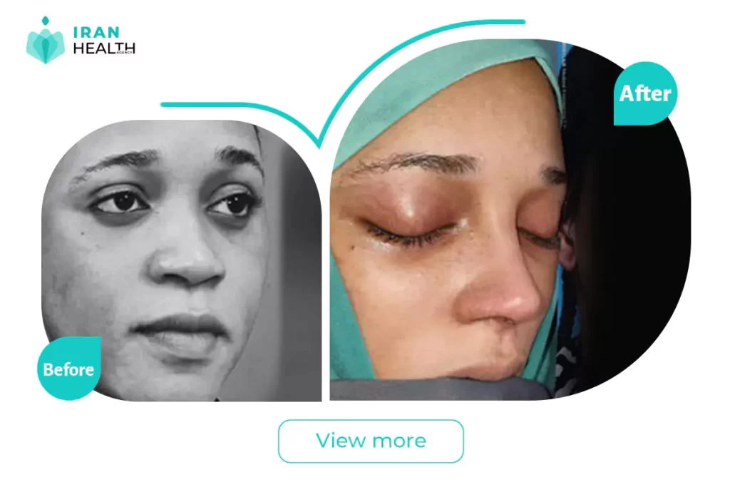 ethnic rhinoplasty in Iran before after photos