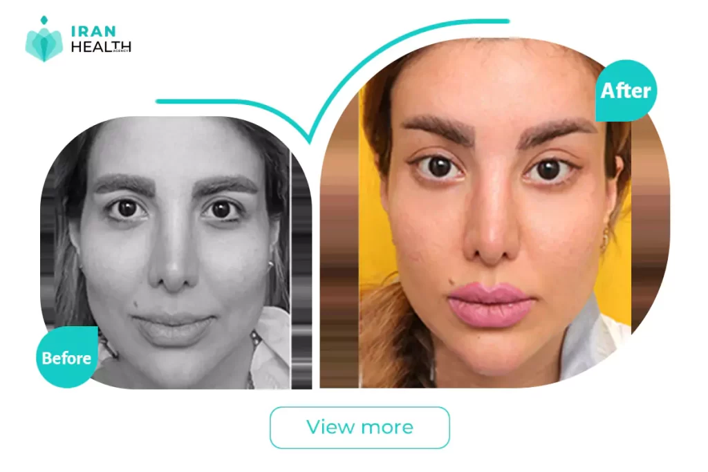 Facial Bone Contouring before after