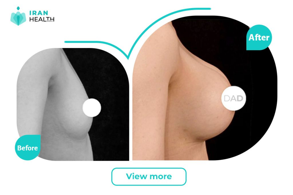 BREAST AUGMENTATION IN IRAN before after photos