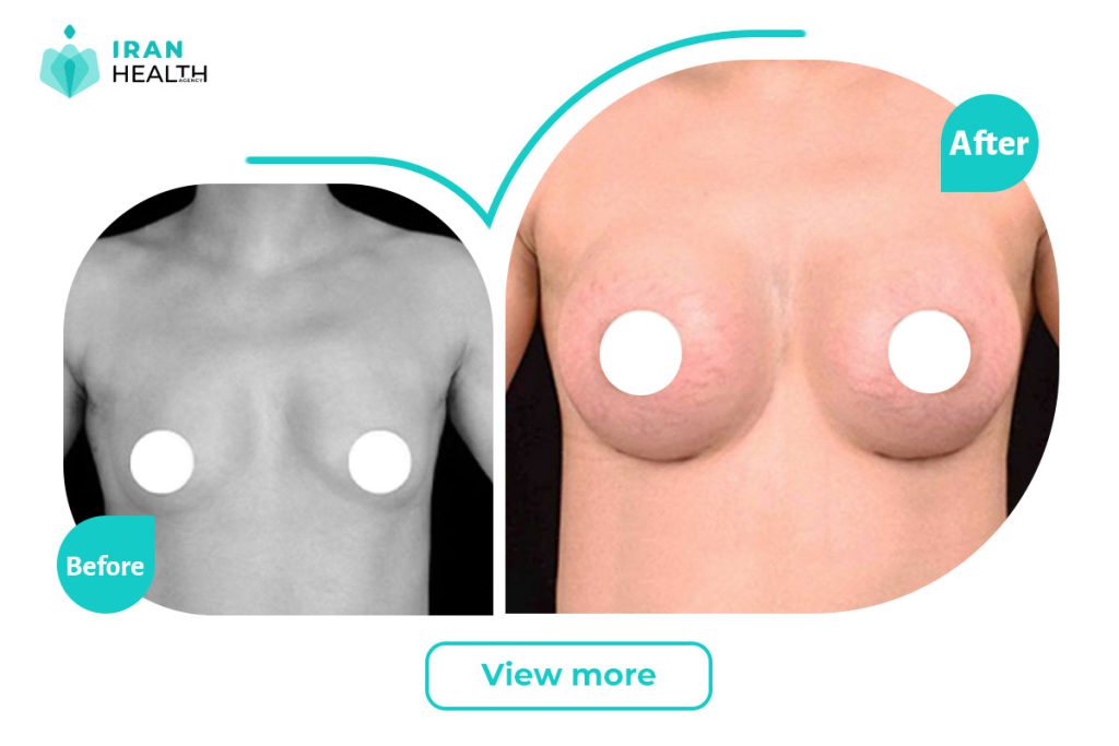 Breast transplant in iran before after photos(1)