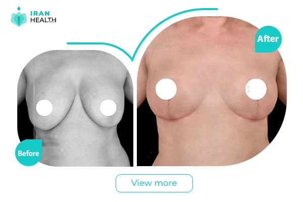 Breast implant revision in iran