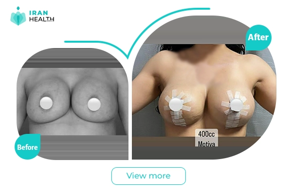 Breast implant revision in iran