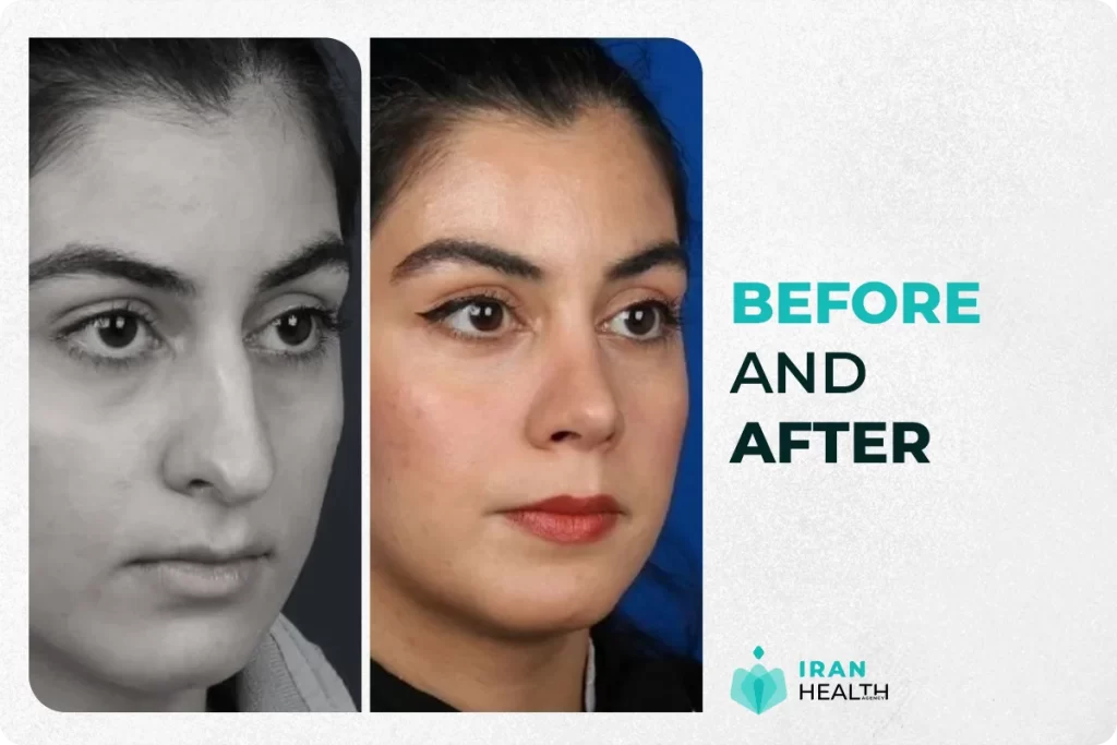 septoplasty in iran before and after