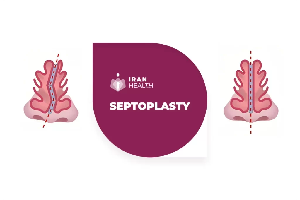 septoplasty 1