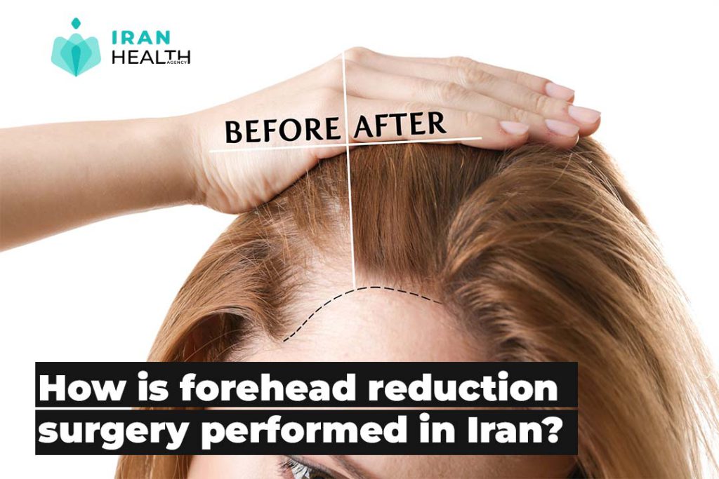 How is forehead reduction surgery performed in Iran?