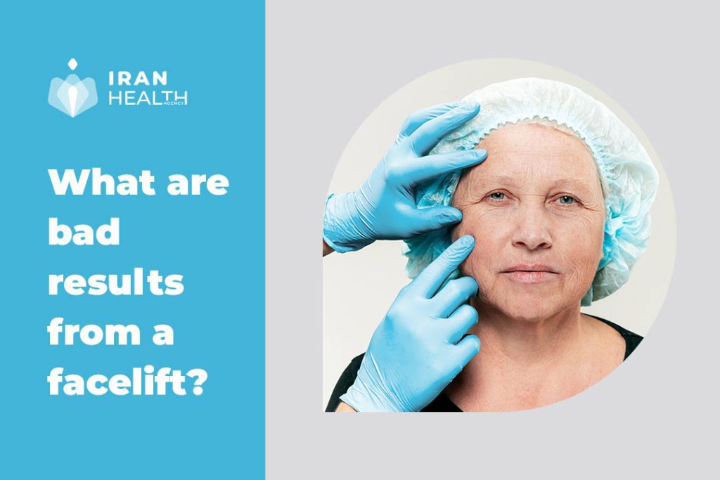 What are bad results from a facelift?