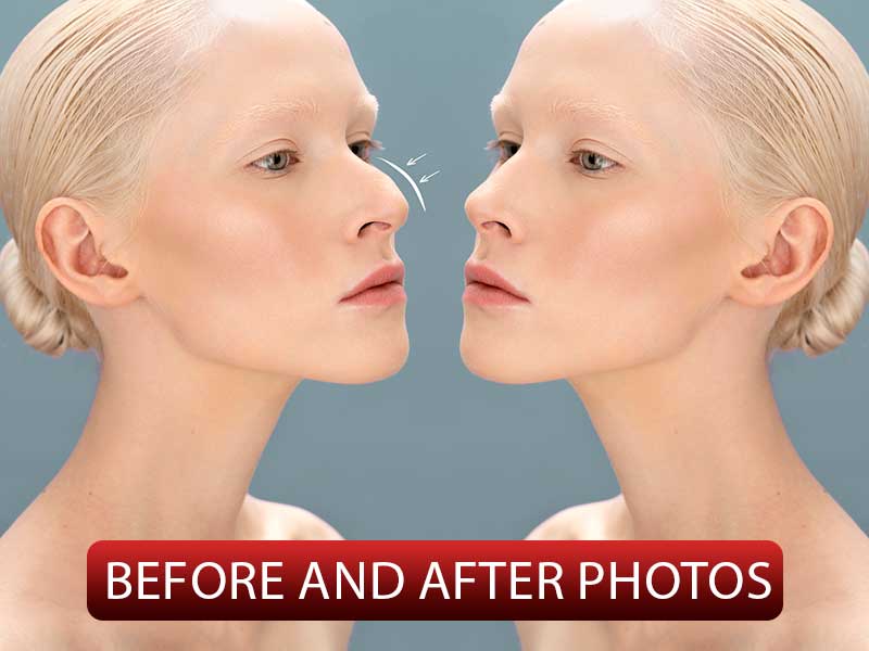 rhinoplasty-before-and-after-photos
