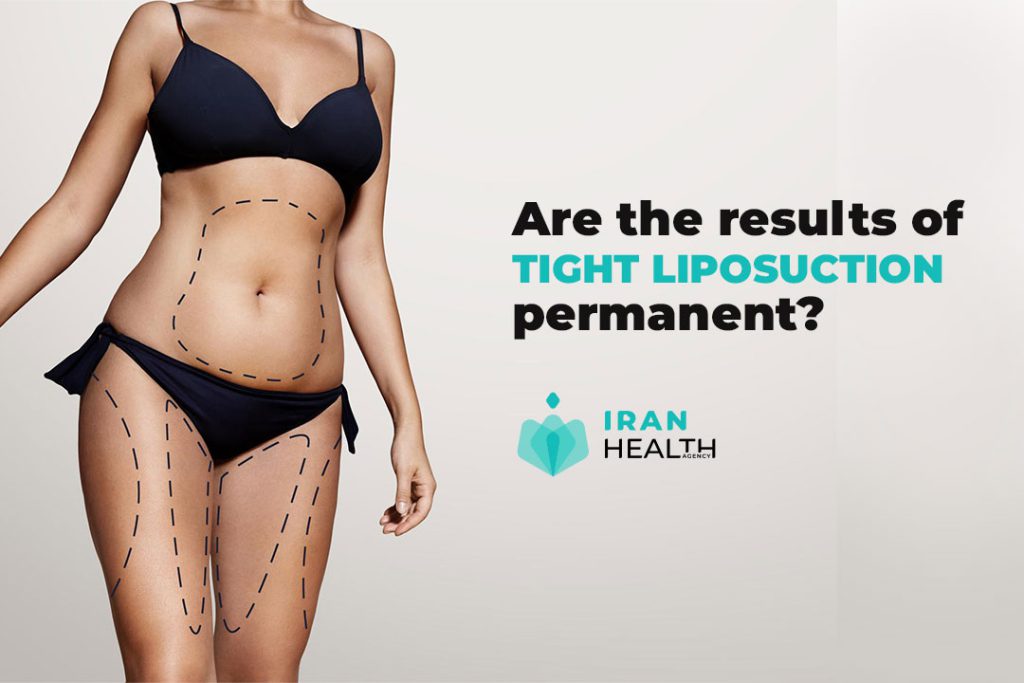 Are the results of tight liposuction permanent?