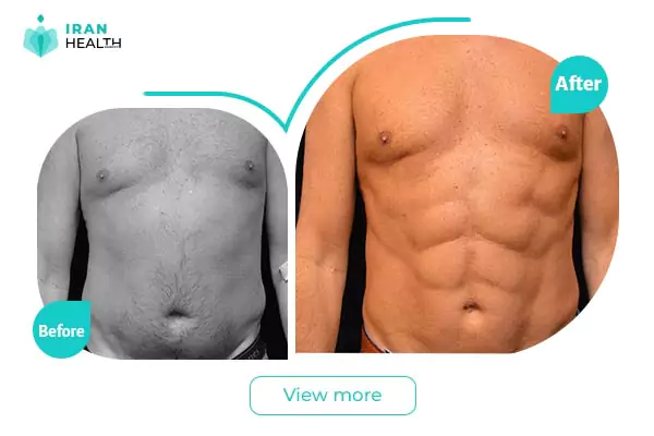 Abdominal Etching before after photos in Iran