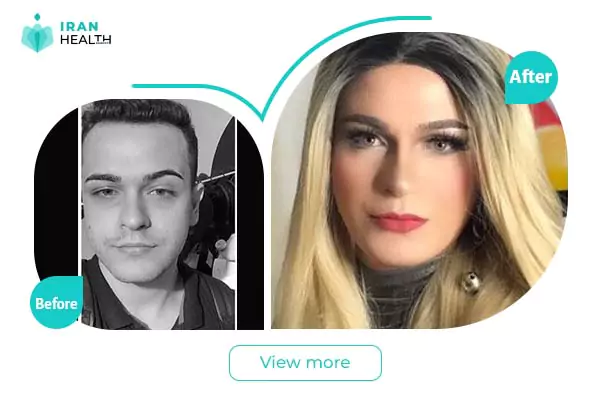 Trans Gender Surgery Before & After photos