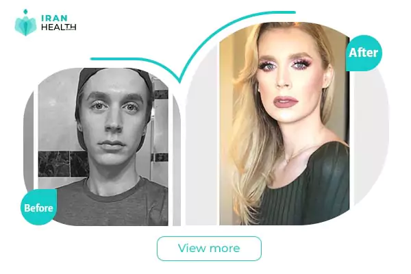 Trans Gender Surgery Before & After photos