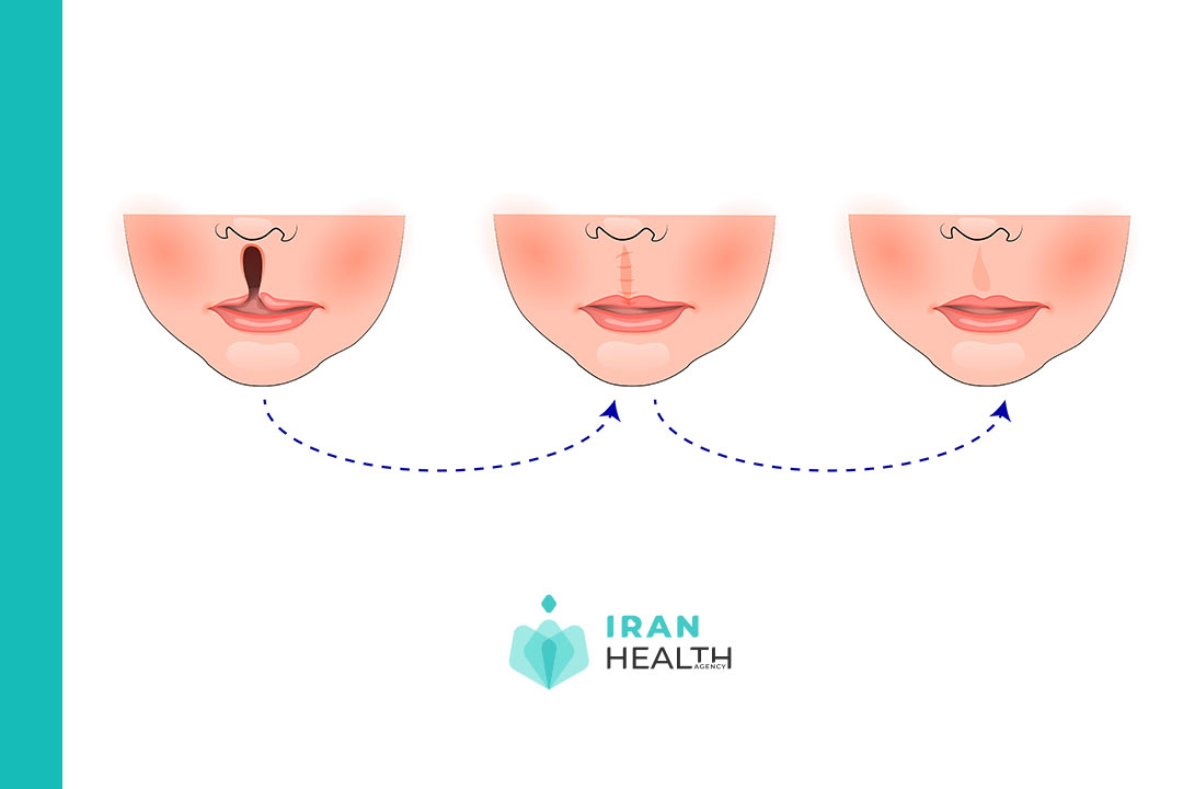 Cleft Lip And Palate In Iran | Best Surgeon & Cost In Iran