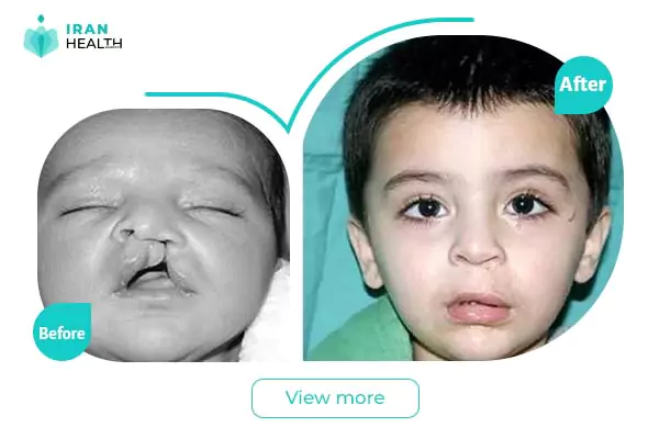 cleft lip and palate repair in iran