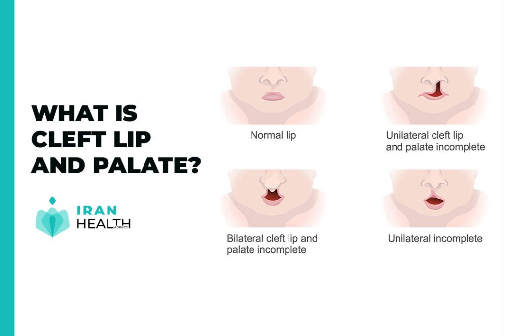 what is Cleft lip and palate