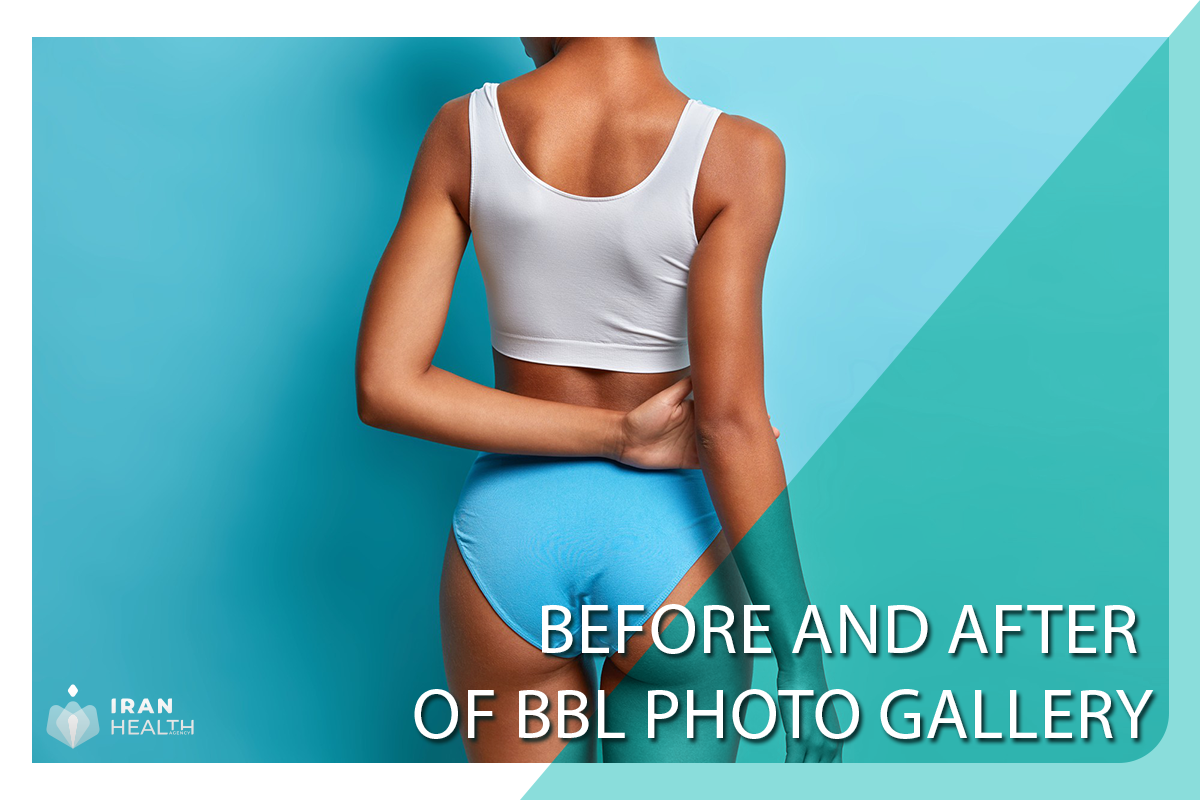 Before and After Of BBL Photo Gallery