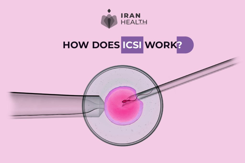 2 How Does ICSI Work