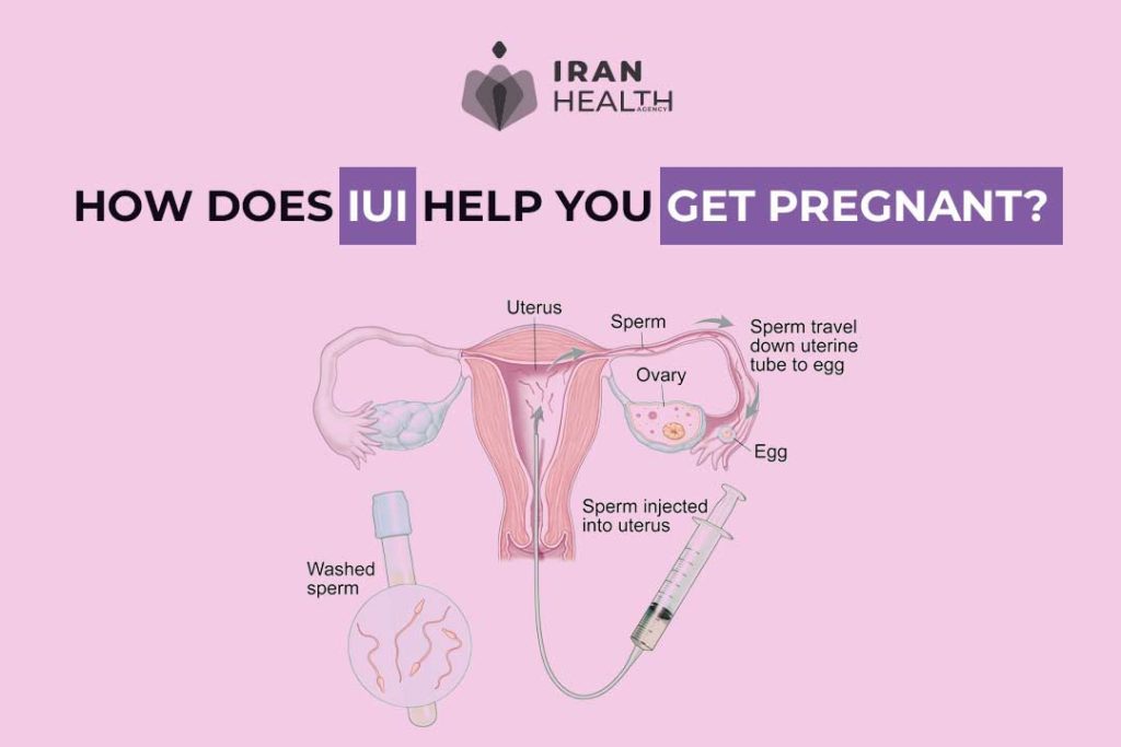 How does IUI help you get pregnant?