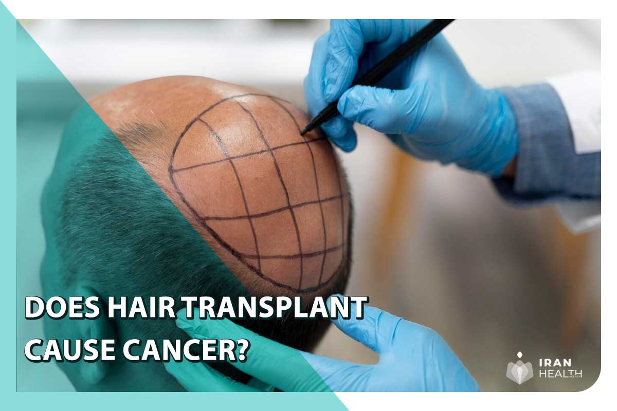 Hair Transplant Cause Cancer