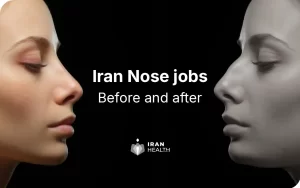 Iran nose jobs before and after