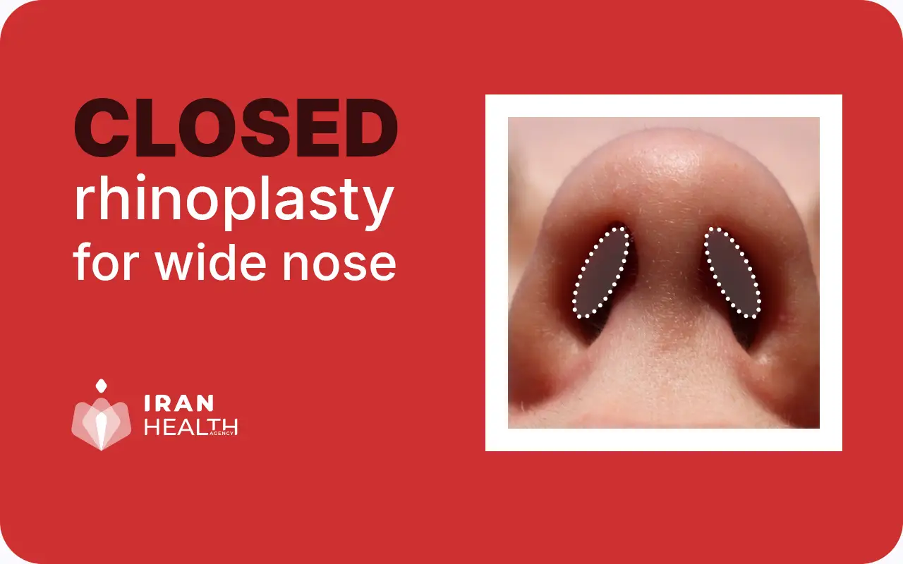 closed Rhinoplasty for wide nose