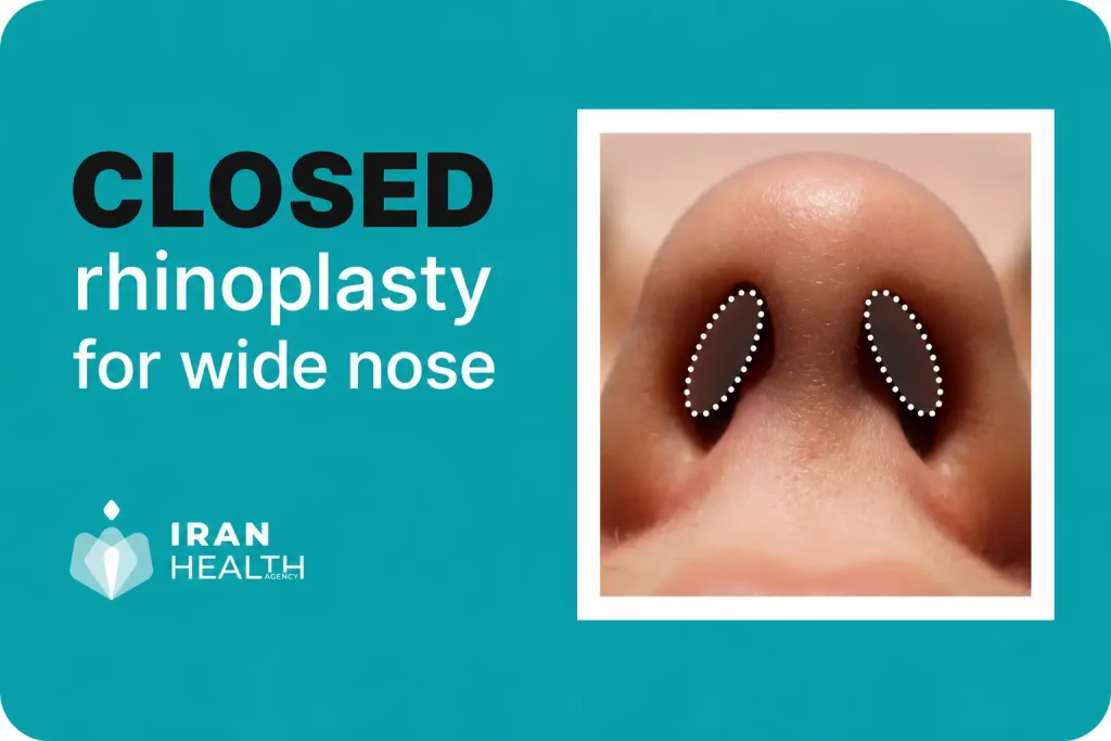 closed ehinoplasty