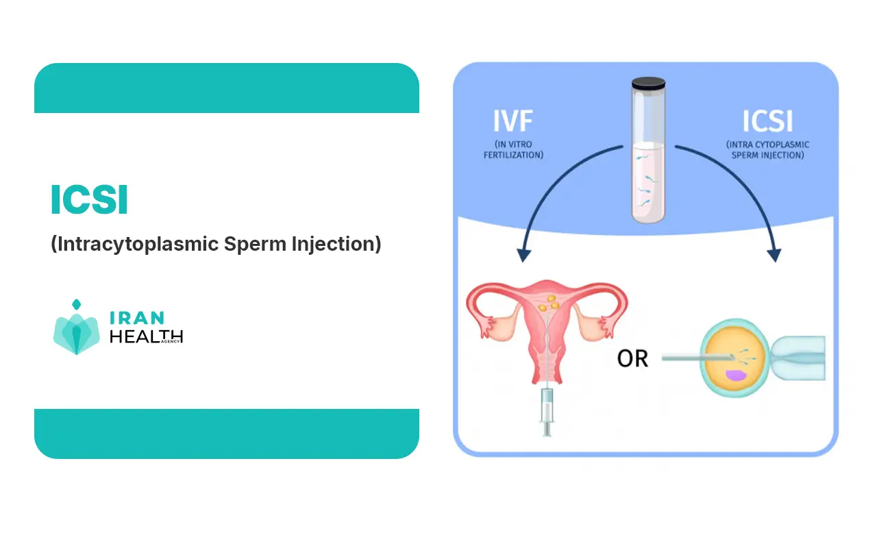 How prevalent is infertility in Iran ICSI