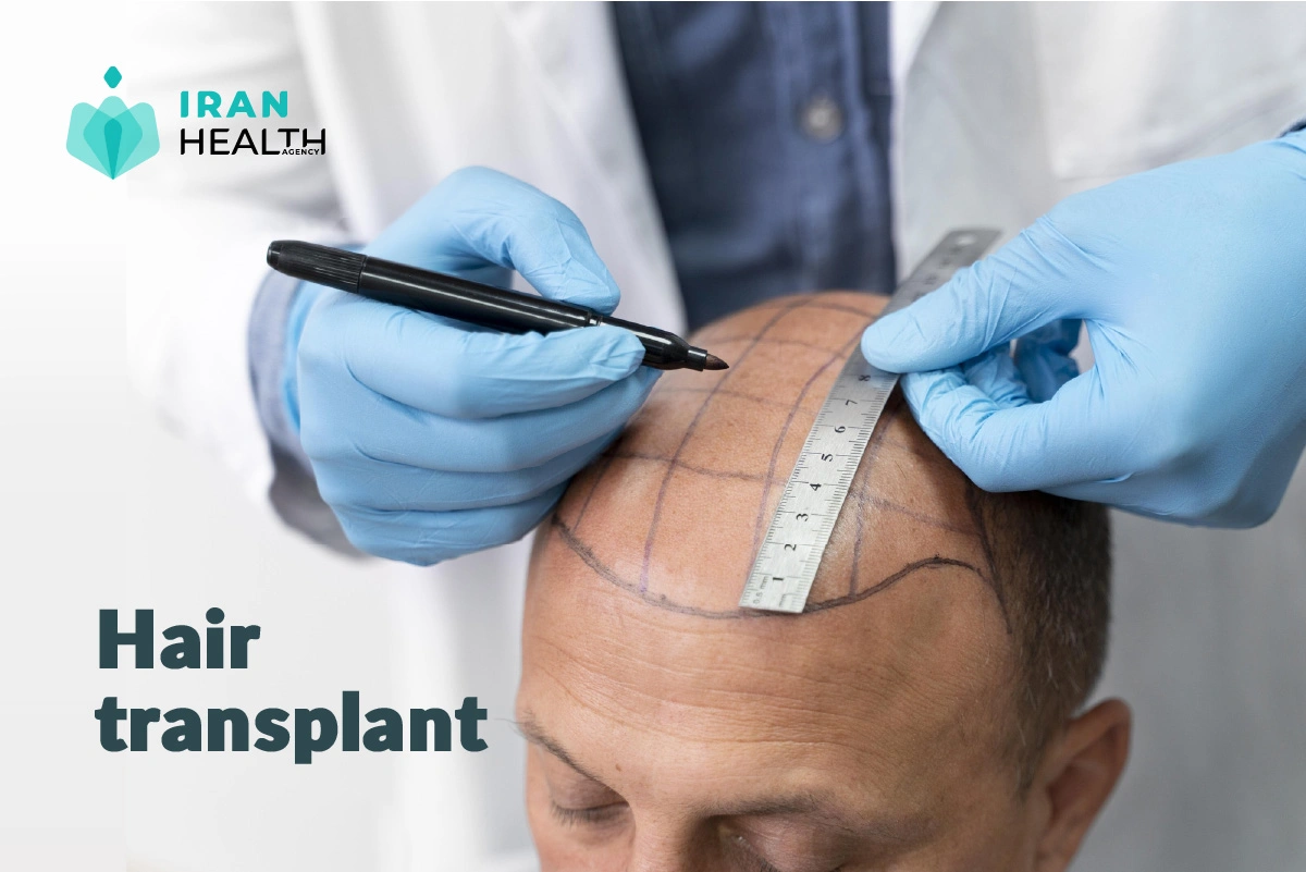 Iran's medical tourism statistics hair transplant