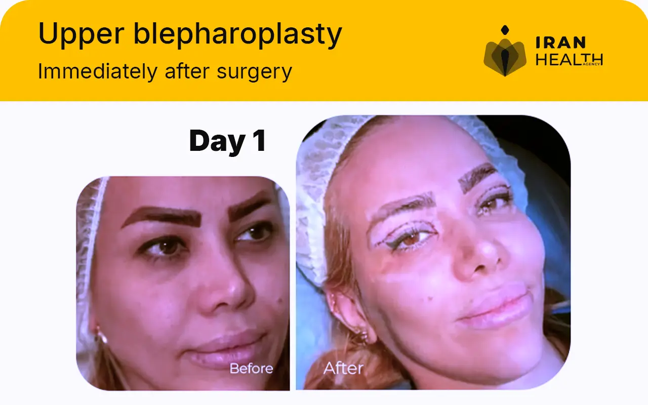 Upper blepharoplasty recovery photos day by day 1 day