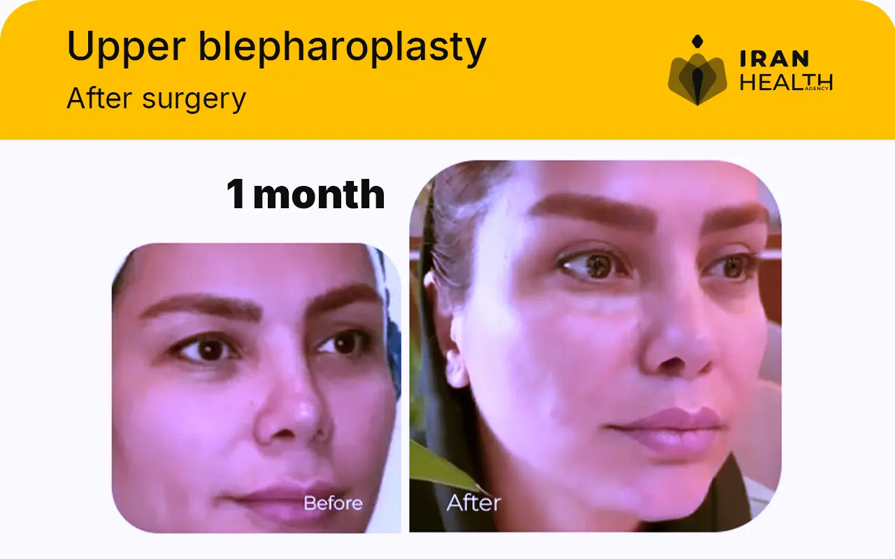 Upper blepharoplasty recovery photos day by day 1 month