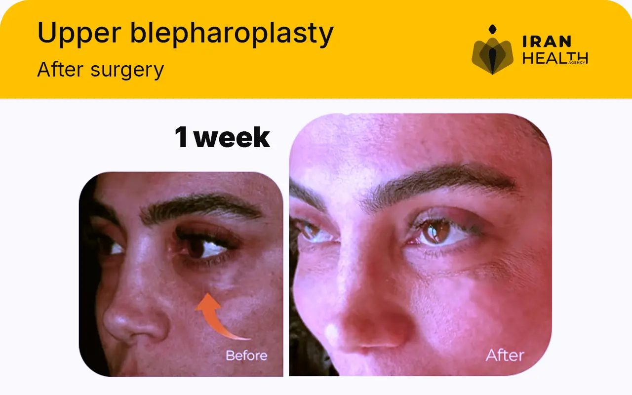 Upper blepharoplasty recovery photos day by day 1 week