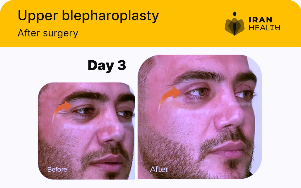 Upper blepharoplasty recovery photos day by day 3 day