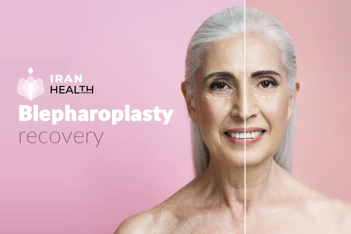 blepharoplasty procedure recovery