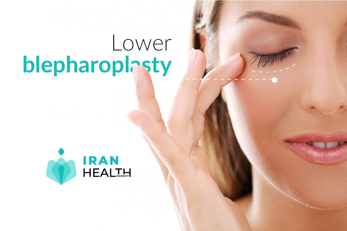 lower blepharoplasty procedure