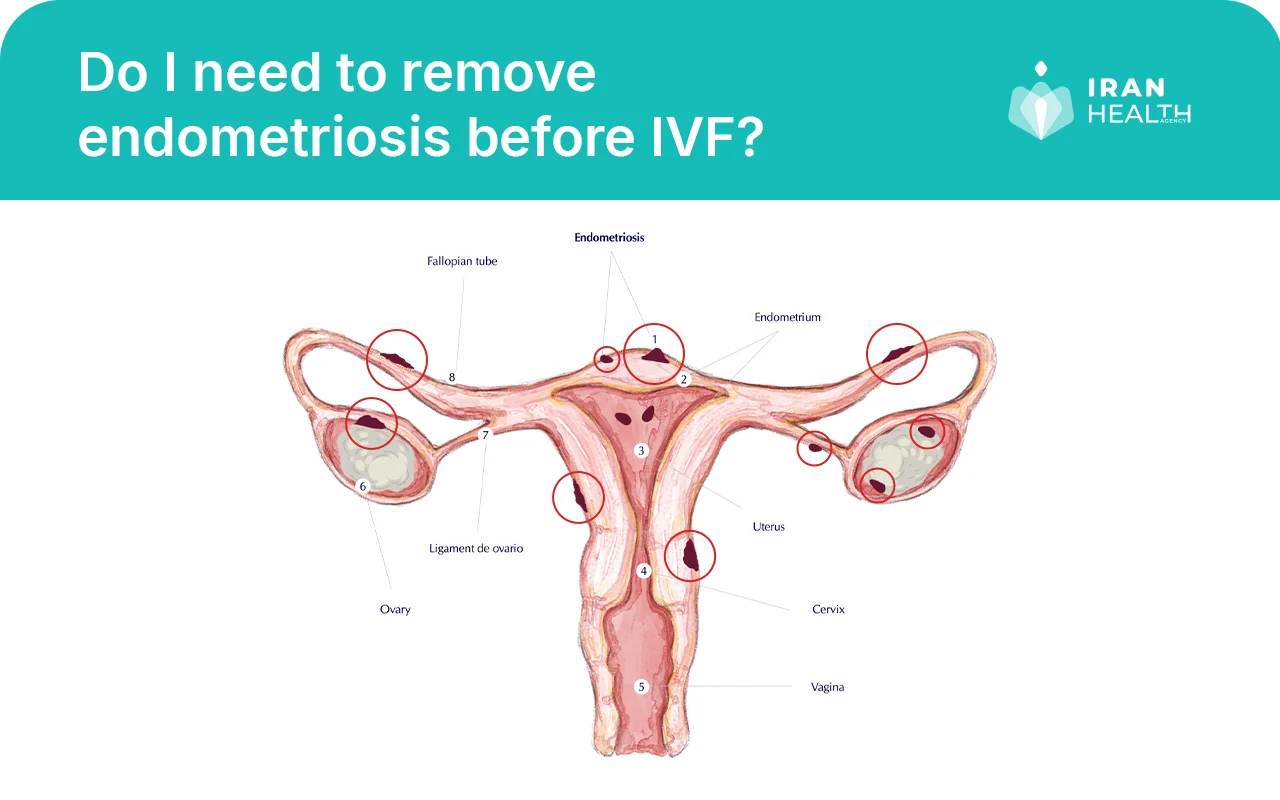 Do I need to remove endometriosis before IVF