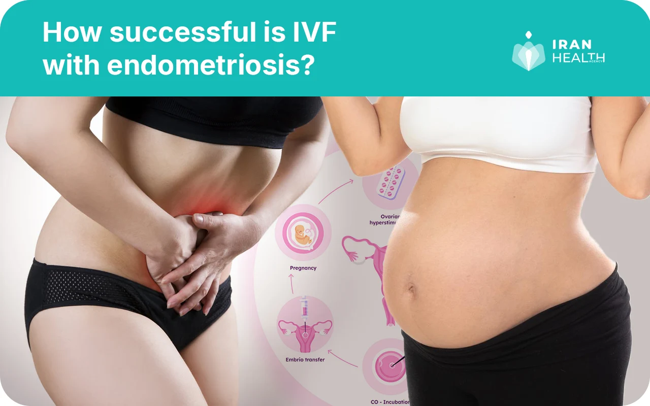 How successful is IVF with endometriosis