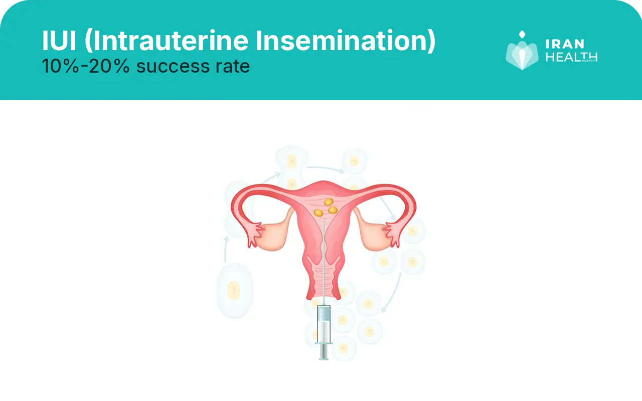 IUI (Intrauterine Insemination)