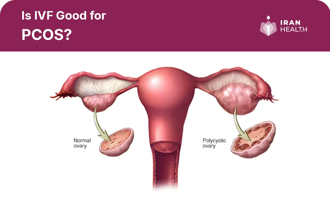 Is IVF Good for PCOS