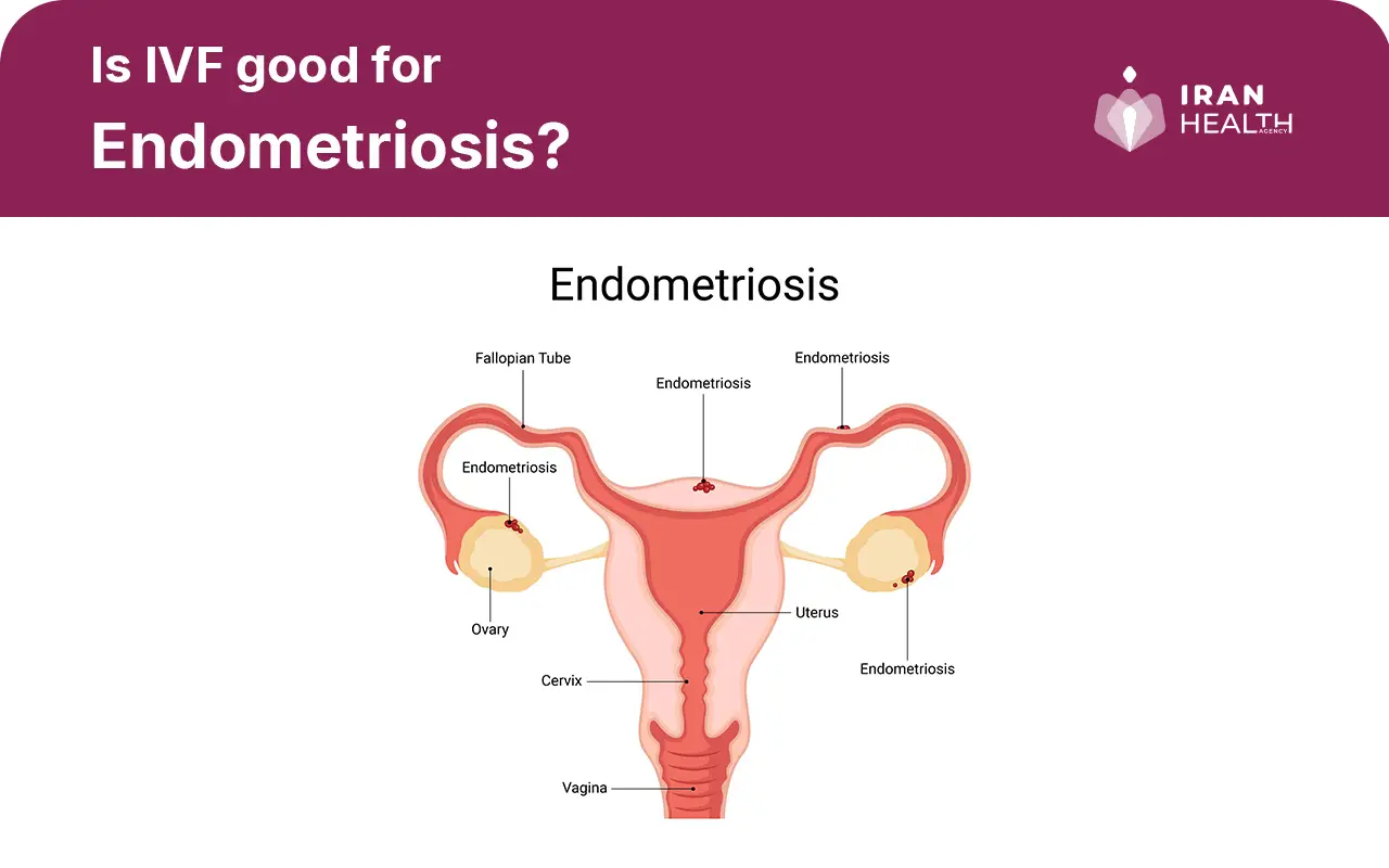 Is IVF Suitable for Endometriosis