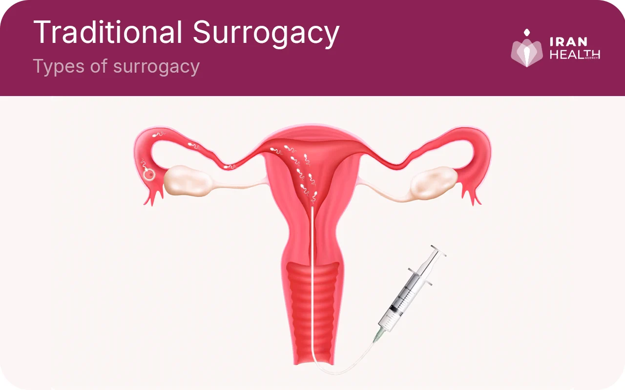 Types of surrogacy, Traditional Surrogacy