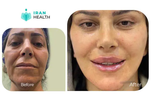 Facelift before and after 1